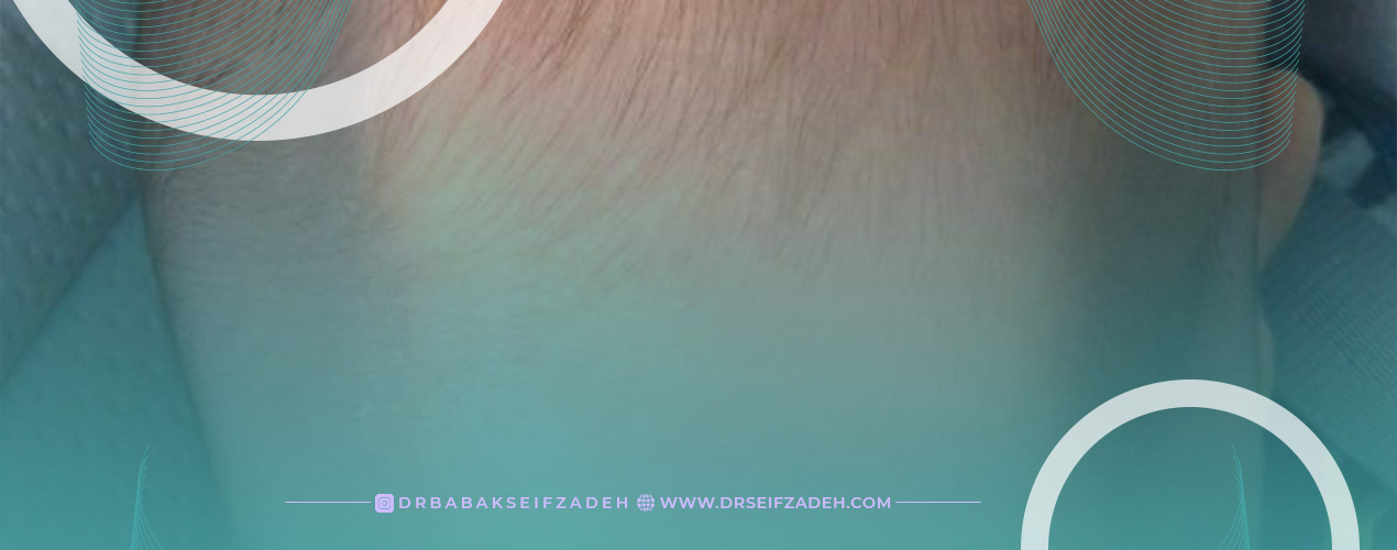 درمان بیماری کرانیوسینوستوز