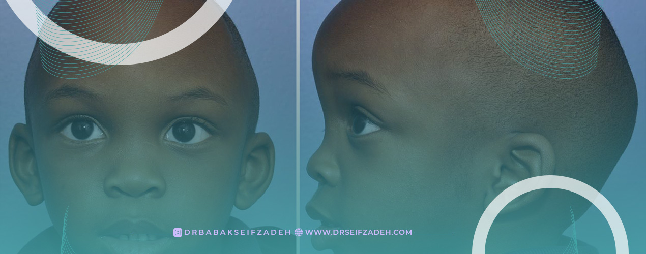 عوارض ناشی از کرانیوسینوستوز