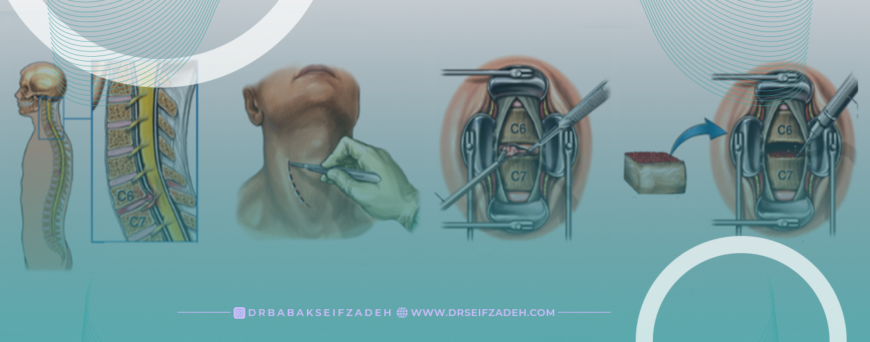 جدیدترین روش درمان دیسک گردن