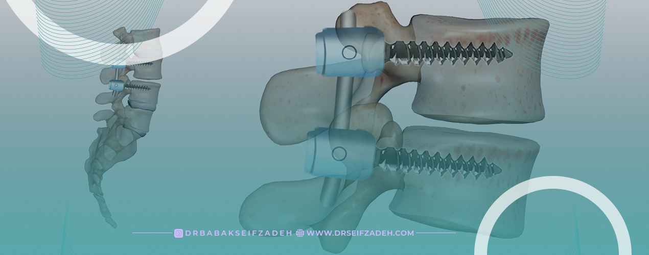 هزینه جراحی فیوژن ستون فقرات
