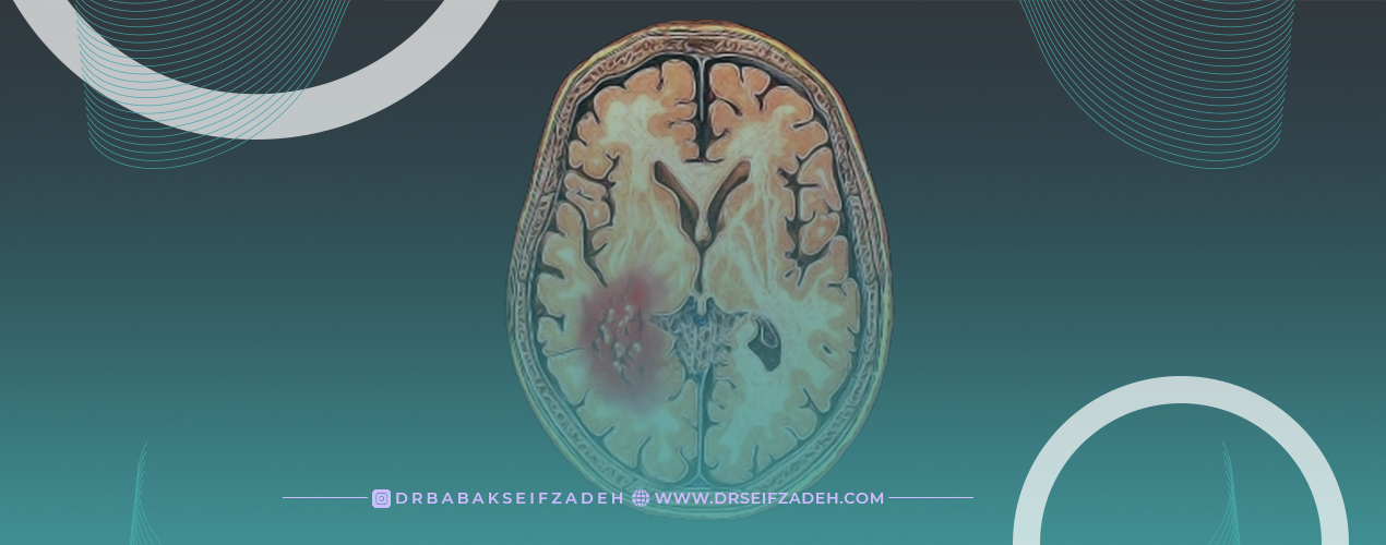 علائم خونریزی مغزی