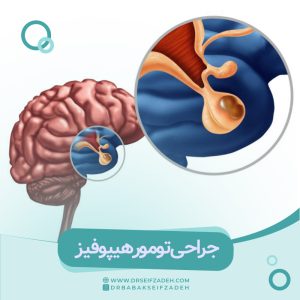 جراحی تومور هیپوفیز
